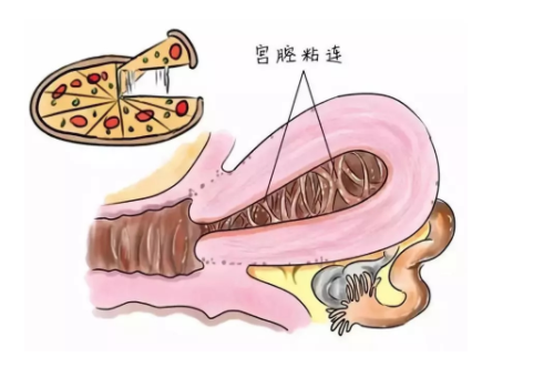 泰国试管婴儿成功案例